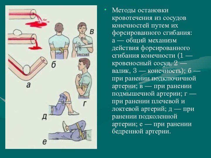 Методы остановки кровотечения из сосудов конечностей путем их форсированного сгибания: а — общий