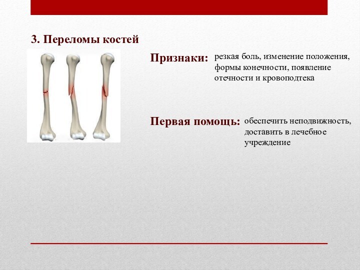 3. Переломы костейПризнаки:резкая боль, изменение положения, формы конечности, появление отечности и кровоподтекаПервая