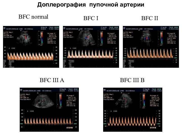 BFC normalBFC IBFC IIBFC III ABFC III BДоплерография пупочной артерии