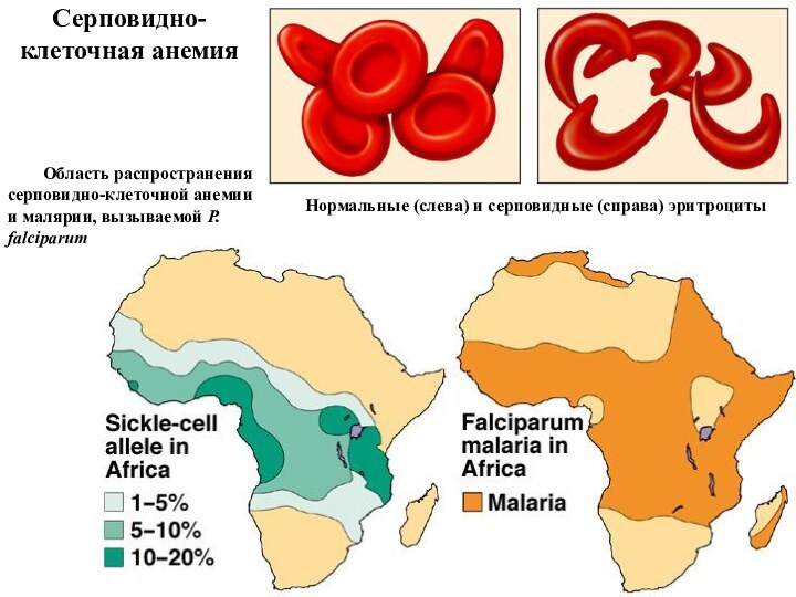 Серповидно-клеточная анемияНормальные (слева) и серповидные (справа) эритроциты    Область распространения