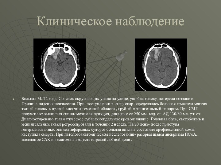 Клиническое наблюдениеБольная М.,72 года. Со слов окружающих упала на улице, ушибла голову,