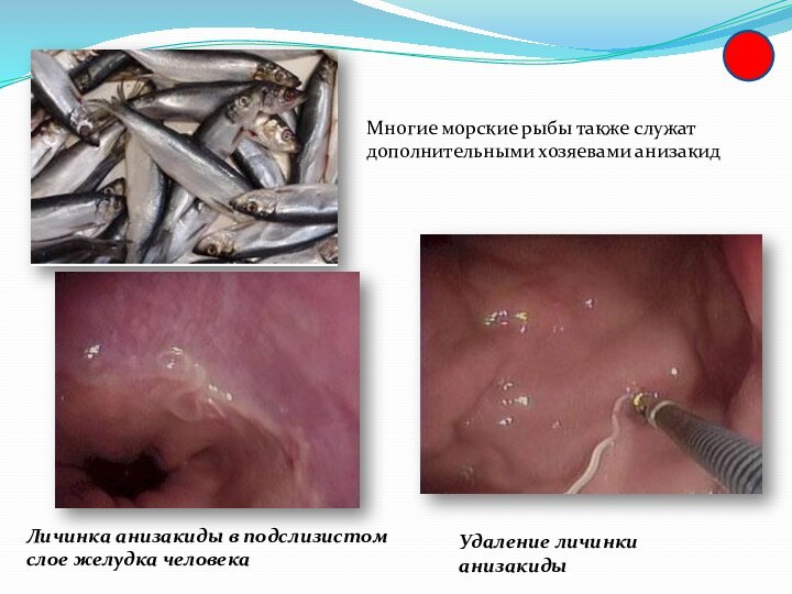Многие морские рыбы также служат дополнительными хозяевами анизакидЛичинка анизакиды в подслизистом слое