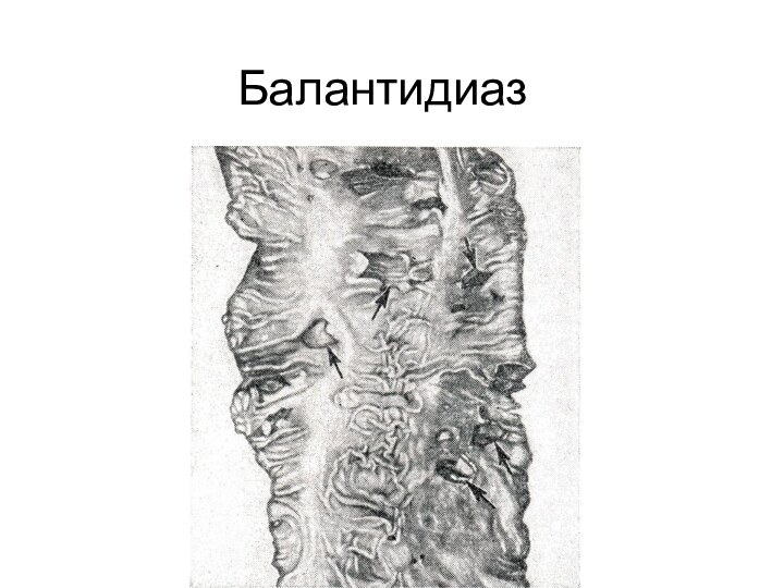 Балантидиаз