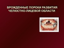 Врожденные пороки развития челюстно-лицевой области