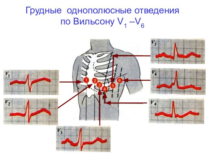 Грудные однополюсные отведения по Вильсону V1 –V6