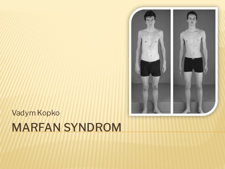 Marfan SyndromVadym Kopko