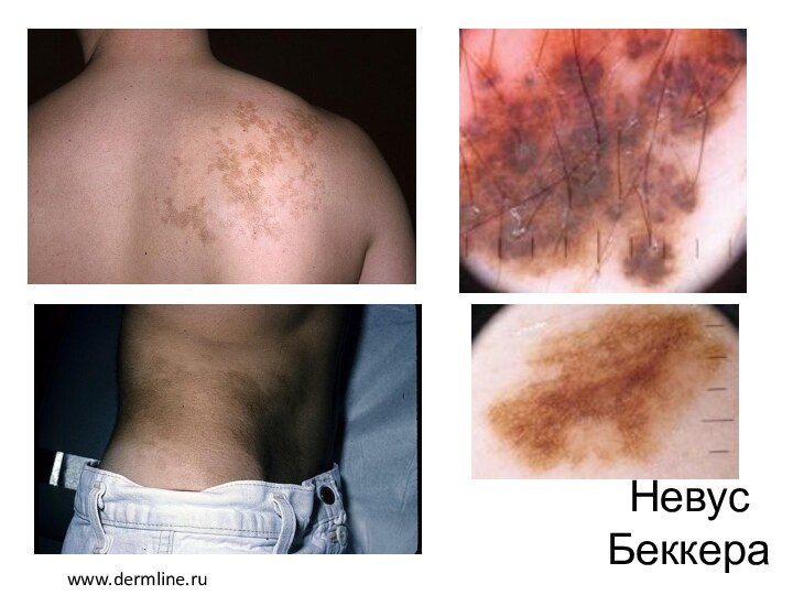 Невус Беккераwww.dermline.ru