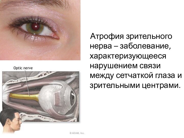 Атрофия зрительного нерва – заболевание, характеризующееся нарушением связи между сетчаткой глаза и зрительными центрами.