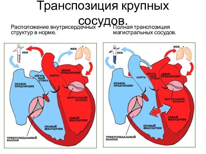 Транспозиция крупных сосудов.Расположение внутрисердечных структур в норме.Полная транспозиция магистральных сосудов.