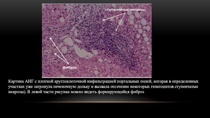 Картина АИГ с плотной круглоклеточной инфильтрацией портальных полей, которая в определенных участках