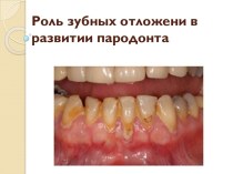 Роль зубных отложени в развитии пародонта