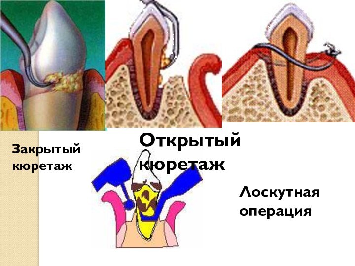 Закрытый кюретажОткрытый кюретаж Лоскутная операция