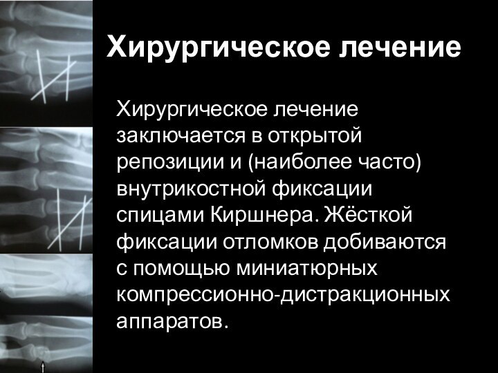 Хирургическое лечениеХирургическое лечение заключается в открытой репозиции и (наиболее часто)внутрикостной фиксации спицами