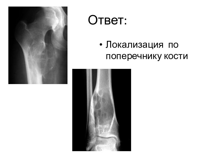 Ответ:Локализация по поперечнику кости