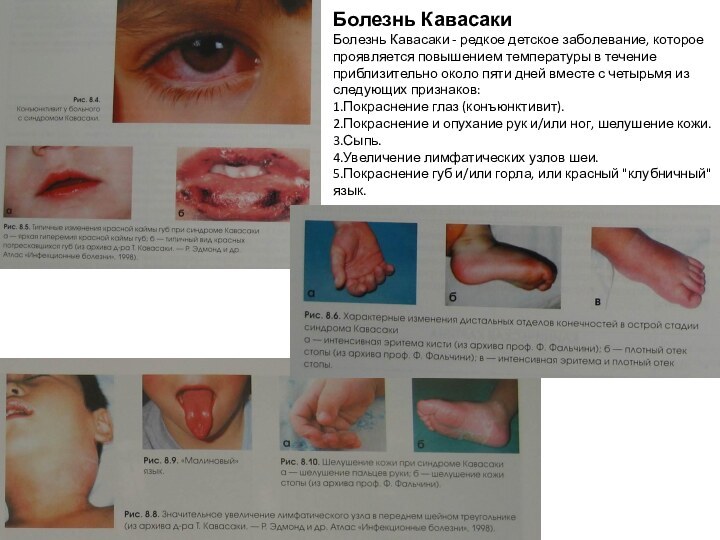 Болезнь КавасакиБолезнь Кавасаки - редкое детское заболевание, которое проявляется повышением температуры в