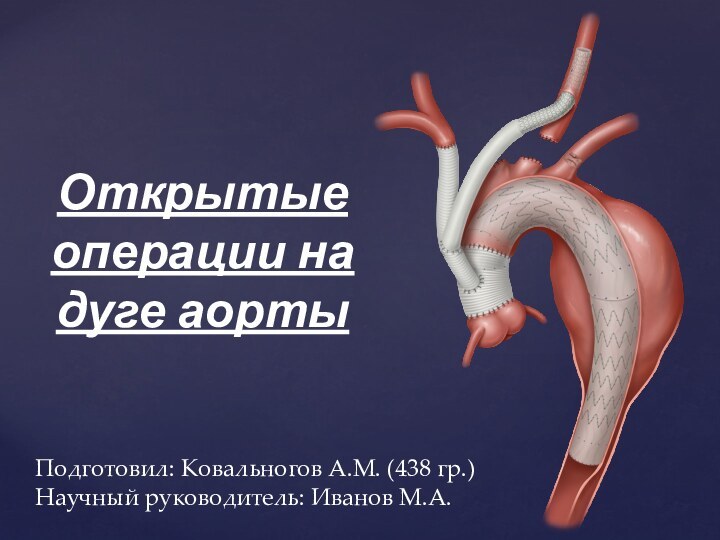 Открытые операции на дуге аортыПодготовил: Ковальногов А.М. (438 гр.)Научный руководитель: Иванов М.А.