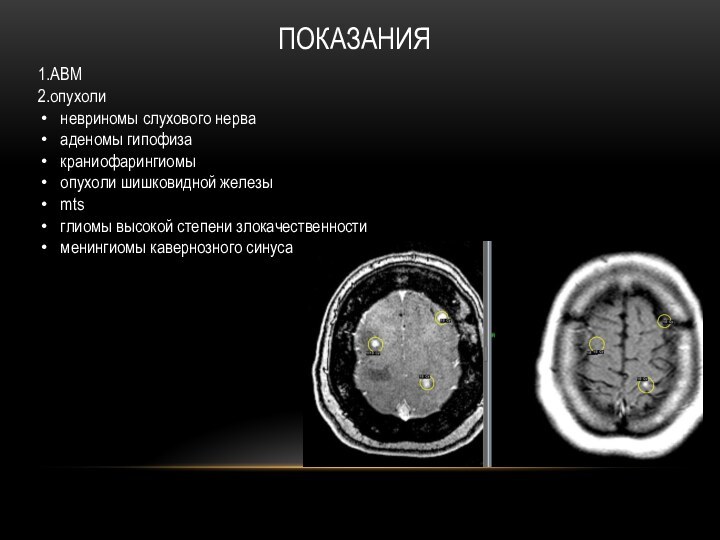 Рак мозга степени. Менингиома головного мозга классификация. Менингиома кавернозного синуса кт. Невринома зрительного нерва кт.