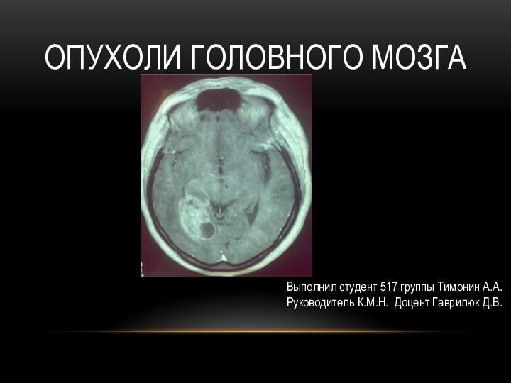 Опухоли головного мозгаВыполнил студент 517 группы Тимонин А.А.Руководитель К.М.Н. Доцент Гаврилюк Д.В.