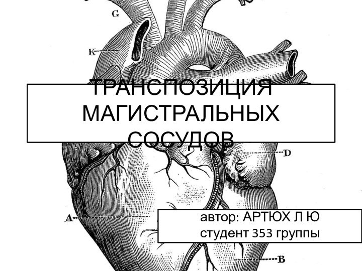 ТРАНСПОЗИЦИЯ МАГИСТРАЛЬНЫХ СОСУДОВавтор: АРТЮХ Л Ю студент 353 группы