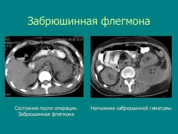 Забрюшинная флегмонаНагноение забрюшинной гематомыСостояние после операции.Забрюшинная флегмона