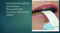 Наложение зубных протезов у больного при полном отсутствии зубов