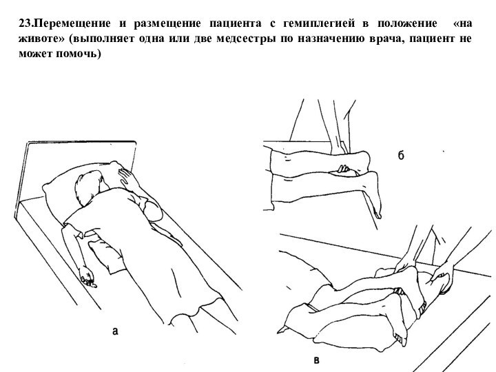 23.Перемещение и размещение пациента с гемиплегией в положение «на животе» (выполняет одна