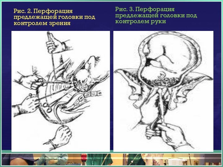 Рис. 2. Перфорация предлежащей головки под контролем зренияРис. 3. Перфорация предлежащей головки под контролем руки