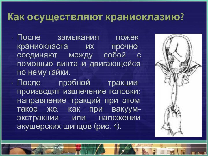 Как осуществляют краниоклазию?После замыкания ложек краниокласта их прочно соединяют между собой с помощью винта