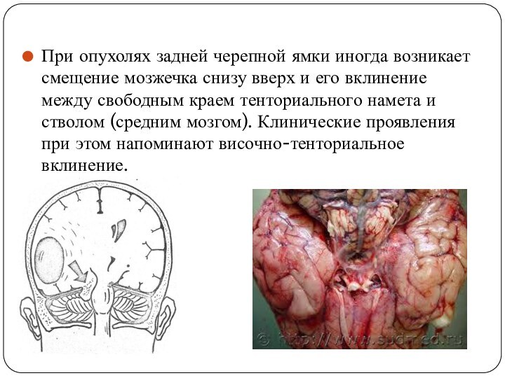 При опухолях задней черепной ямки иногда возникает смещение мозжечка снизу вверх и