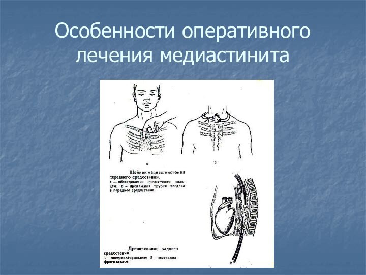 Особенности оперативного лечения медиастинита