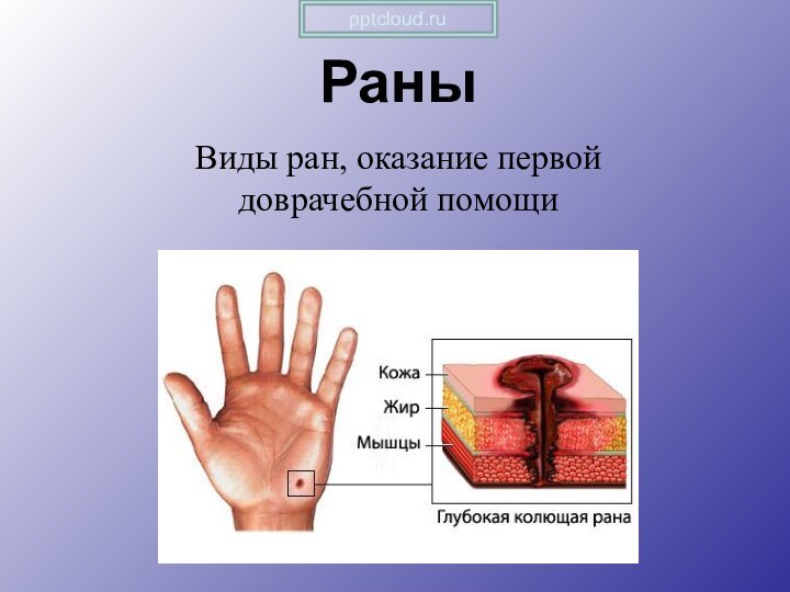 РаныВиды ран, оказание первой доврачебной помощи