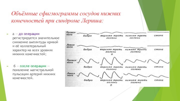 Объёмные сфигмограммы сосудов нижних конечностей при синдроме Лериша:а — до операции регистрируется