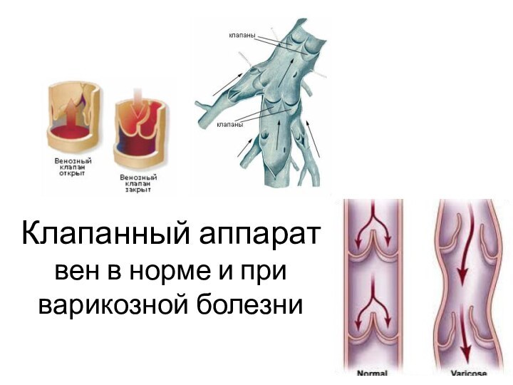 Клапанный аппарат вен в норме и при варикозной болезни