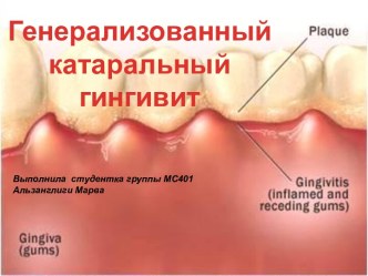 Генерализованный катаральный гингивит