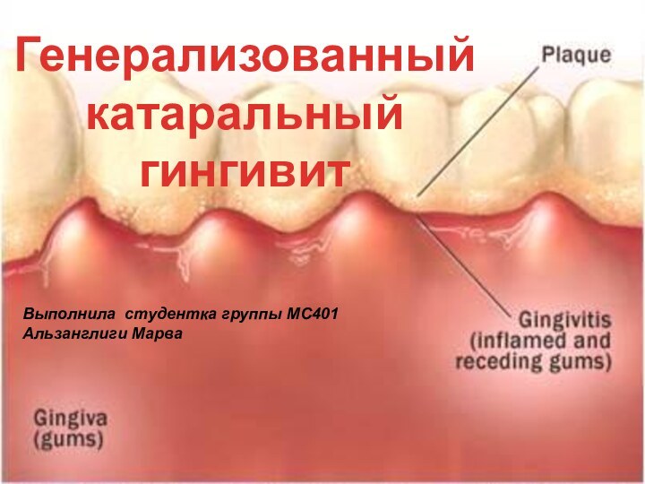 Генерализованный катаральный гингивитВыполнила студентка группы МС401Альзанглиги Марва