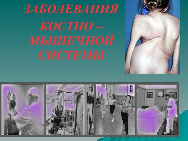 ЗАБОЛЕВАНИЯ КОСТНО – МЫШЕЧНОЙ СИСТЕМЫ