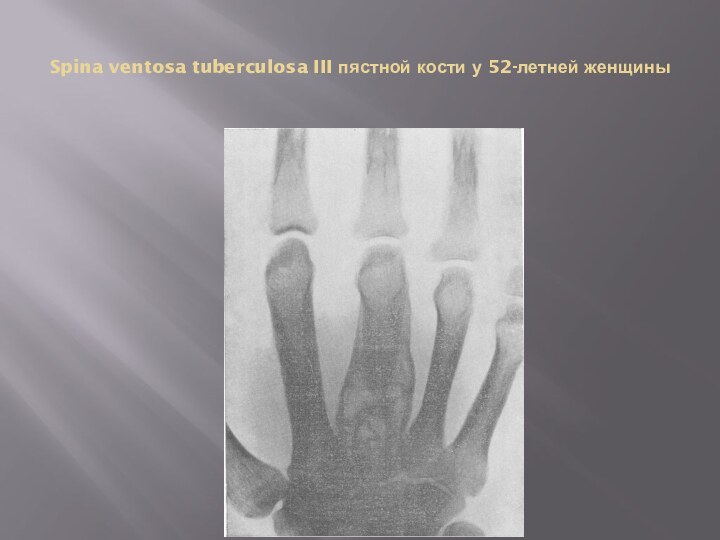 Spina ventosa tuberculosa III пястной кости у 52-летней женщины