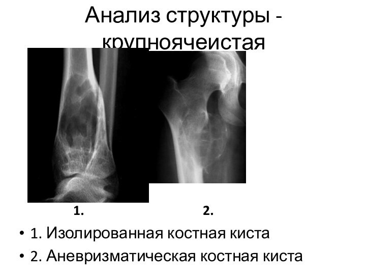 Анализ структуры - крупноячеистая1. Изолированная костная киста2. Аневризматическая костная киста1.2.