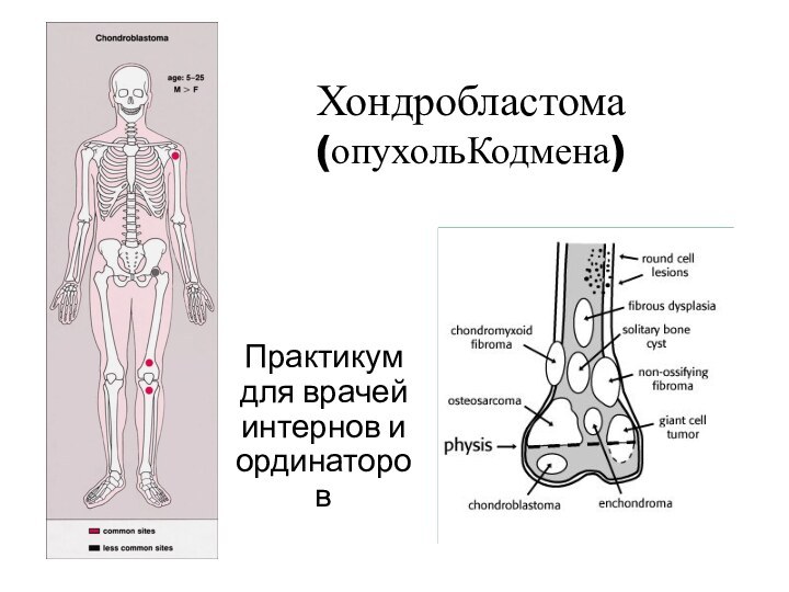 Хондробластома (опухольКодмена)Практикум для врачей интернов и ординаторов