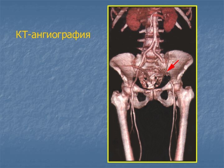 КТ-ангиография