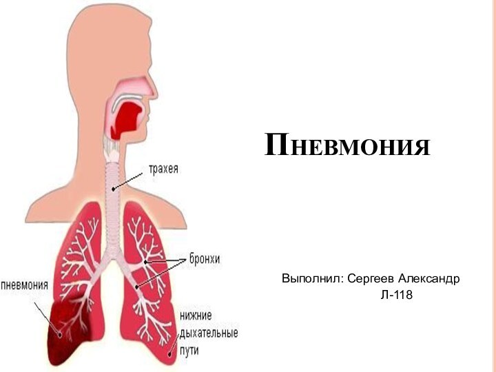 ПневмонияВыполнил: Сергеев АлександрЛ-118