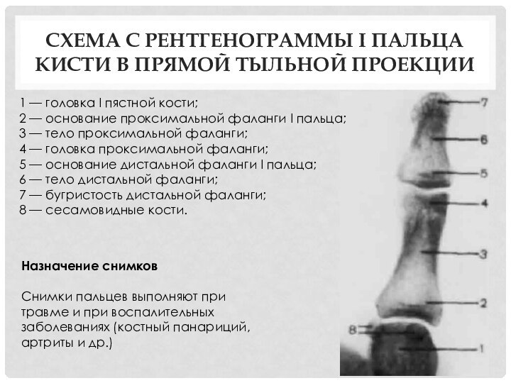 Схема с рентгенограммы I пальца кисти в прямой тыльной проекции1 — головка