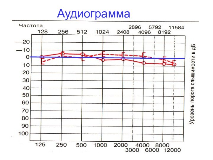 Аудиограмма