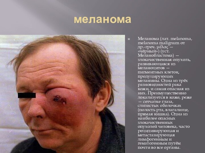 меланомаМеланома (лат. melanoma, melanoma malignum от др.-греч. μέλας — «чёрный») (уст. Меланобластома)