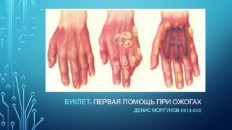 БУКЛЕТ:ПЕРВАЯ ПОМОЩЬ ПРИ ОЖОГАХ