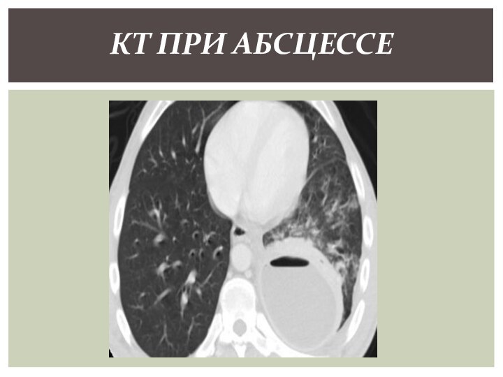 КТ при абсцессе