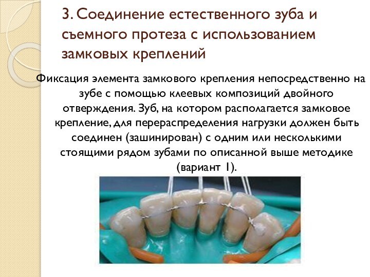 3. Соединение естественного зуба и съемного протеза с использованием замковых крепленийФиксация элемента