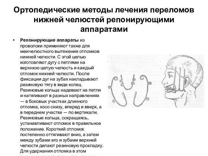 Ортопедические методы лечения переломов нижней челюстей репонирующими аппаратамиРепонирующие аппараты из проволоки применяют также