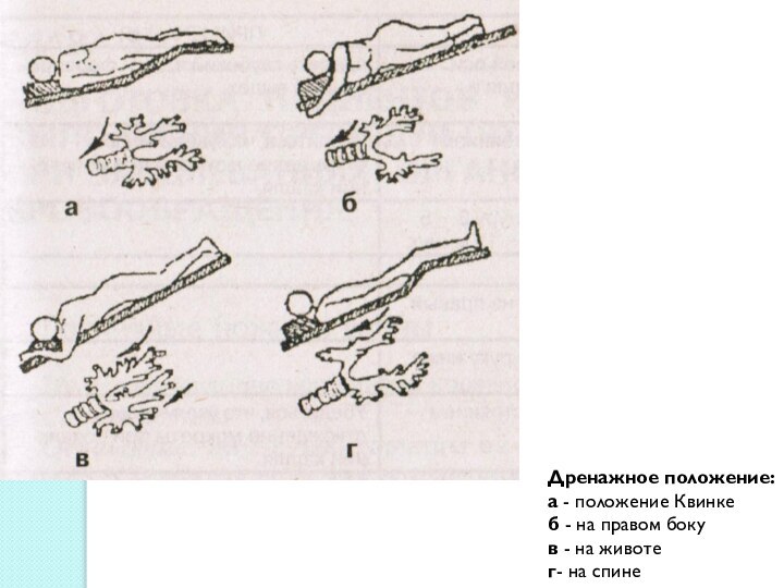 Дренажное положение: а - положение Квинке б - на правом боку  в - на