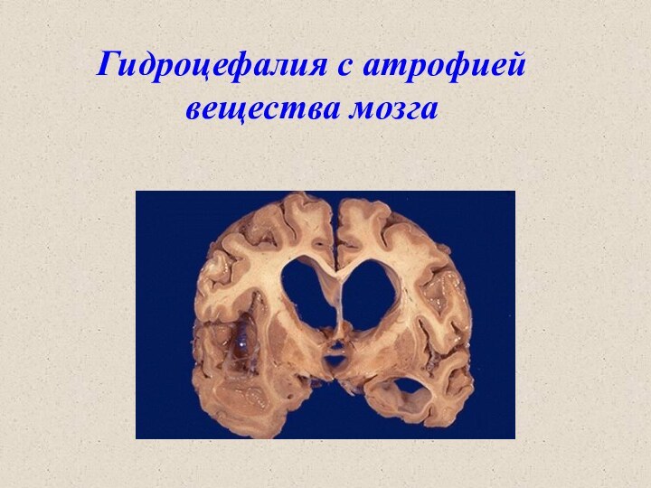Гидроцефалия с атрофией вещества мозга